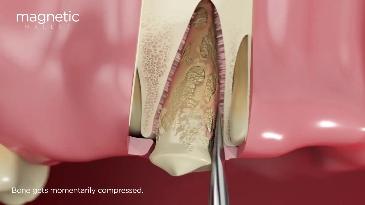 Kit Essential introduction — animated overview of magnetodynamic periotomy